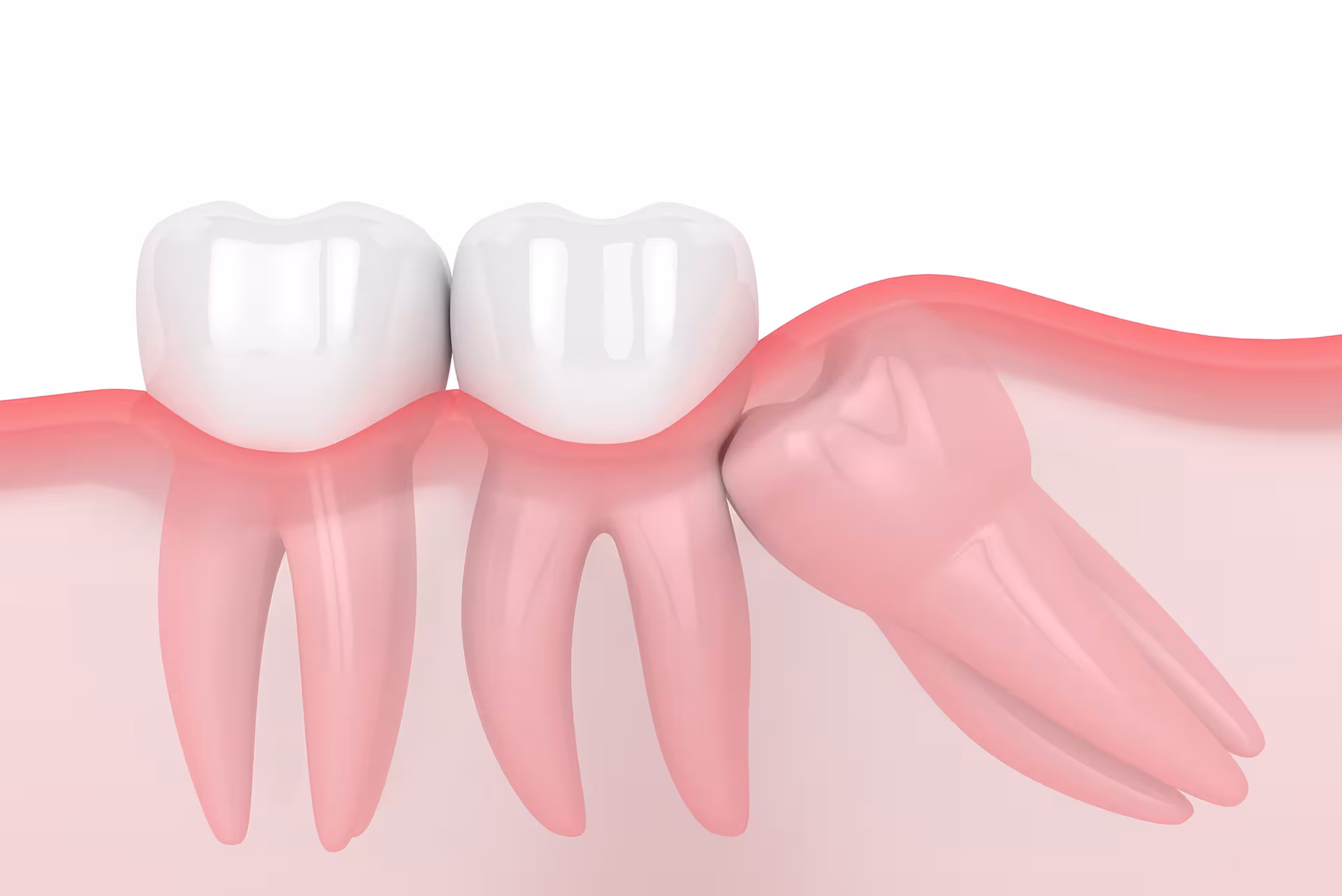 Illustration af frembrydende visdomstand